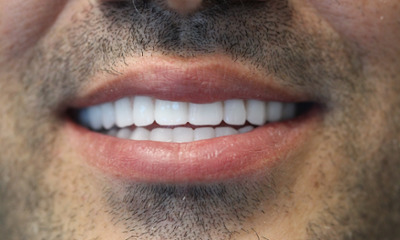 After treatment - All-on-X Implants