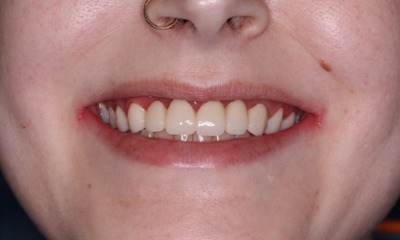 After treatment - Dental Bridge