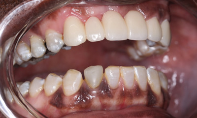 After treatment - Dental Bridge