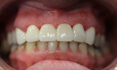 After treatment - Dental Bridge