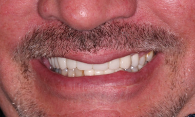 After treatment - Dental Bridge