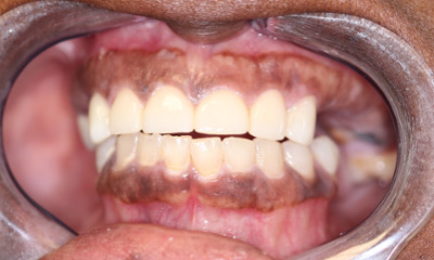 After treatment - Dental Crowns