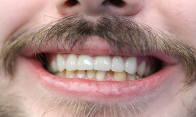 After treatment - Dental Crowns