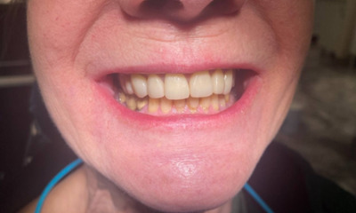 After treatment - Dental Crowns