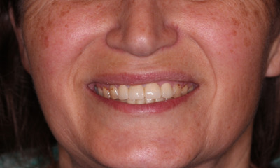 After treatment - Dental Crowns