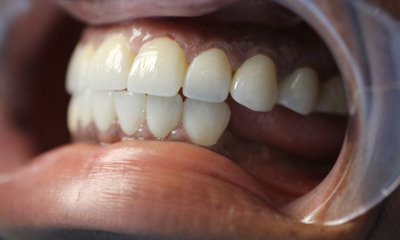 After treatment - Dental Crowns