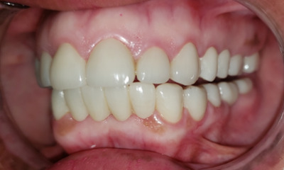After treatment - Full Mouth Crowns