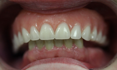 After treatment - Upper Denture