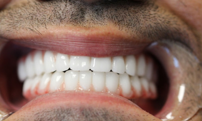 After treatment - All-on-X Implants