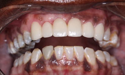 After treatment - Dental Bridge