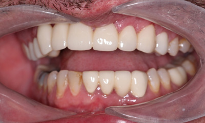 After treatment - Dental Bridge
