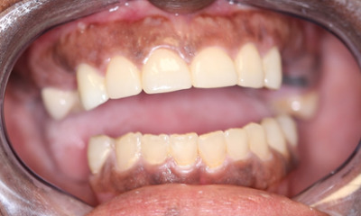 After treatment - Dental Crowns