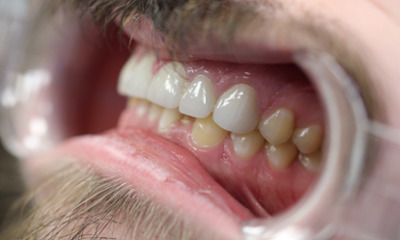 After treatment - Dental Crowns