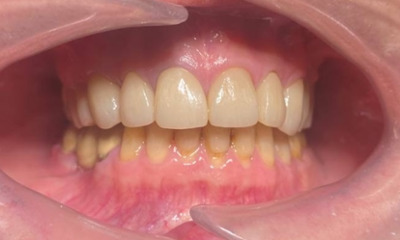 After treatment - Dental Crowns