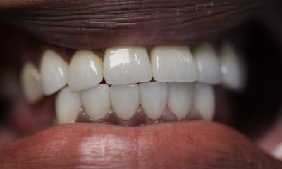 After treatment - Dental Crowns