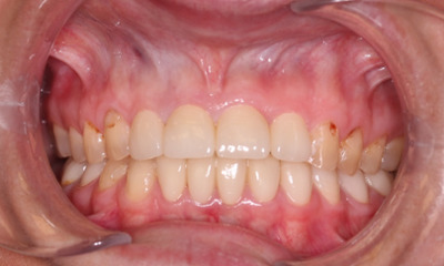 After treatment - Dental Crowns