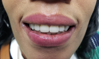 After treatment - Full Mouth Crowns