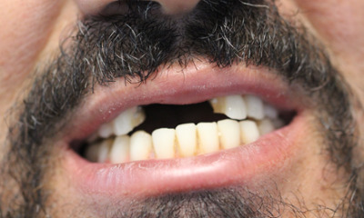 Before treatment - All-on-X Implants