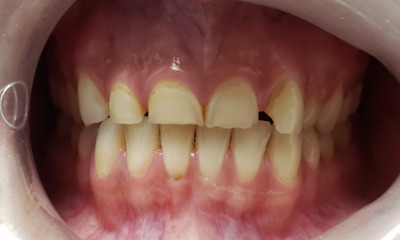 Before treatment - Dental Bridge
