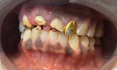 Before treatment - Dental Bridge