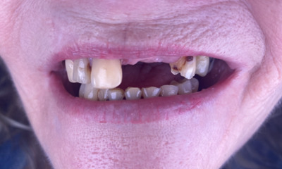 Before treatment - Dental Bridge
