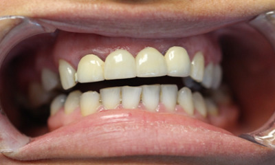 Before treatment - Dental Bridge