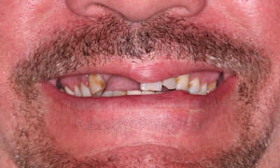 Before treatment - Dental Bridge