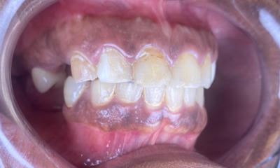 Before treatment - Dental Crowns