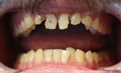 Before treatment - Dental Crowns