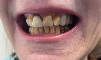 Before treatment - Dental Crowns