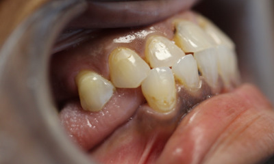 Before treatment - Dental Crowns