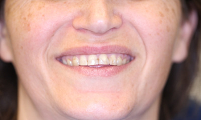 Before treatment - Dental Crowns