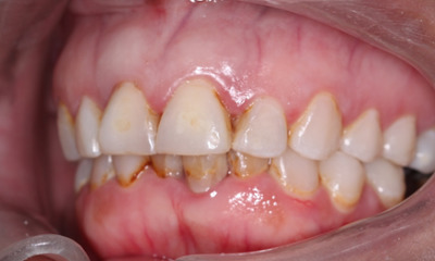 Before treatment - Full Mouth Crowns