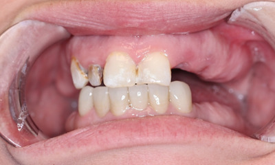 Before treatment - Upper Denture