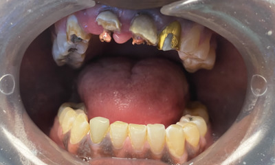 Before treatment - Dental Bridge