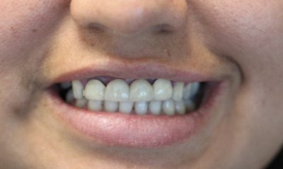 Before treatment - Dental Bridge