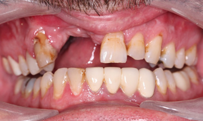 Before treatment - Dental Bridge