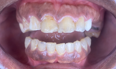 Before treatment - Dental Crowns