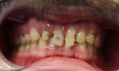 Before treatment - Dental Crowns