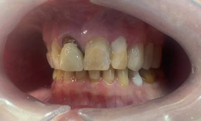 Before treatment - Dental Crowns