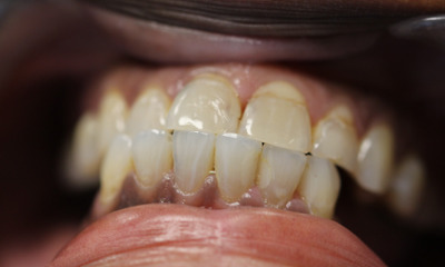 Before treatment - Dental Crowns