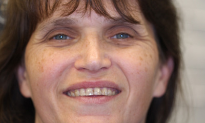 Before treatment - Dental Crowns