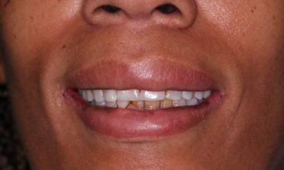 Before treatment - Full Mouth Crowns
